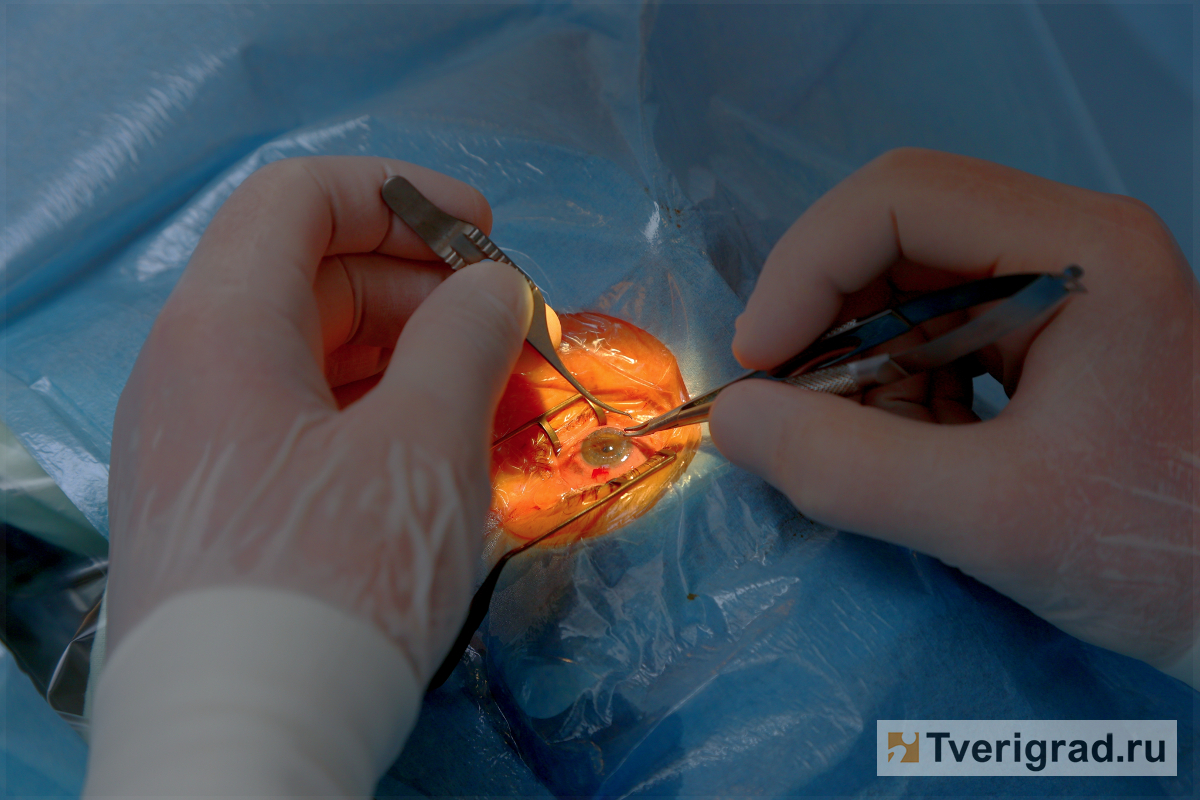 В Твери женщине заменили роговицу глаза донорским трансплантантом